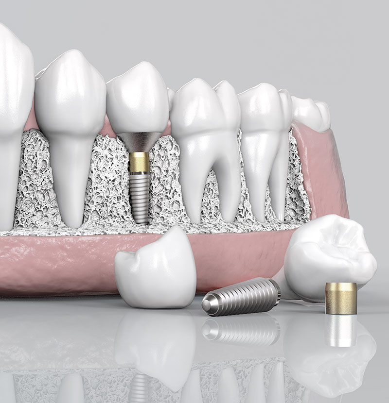 上顎竇增高術植牙